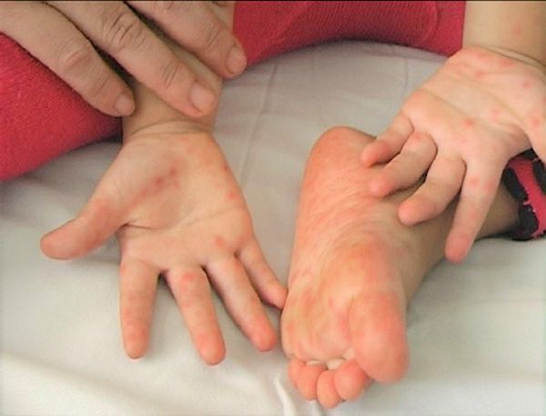 CÁCH PHÒNG BỆNH TAY CHÂN MIỆNG