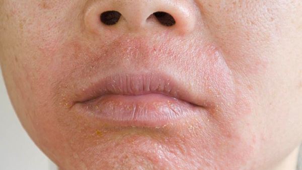 Da nhiễm chì là gì? Cách thải độc da nhiễm chì