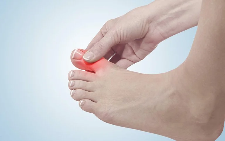 Người bệnh gout ăn gì ngày Tết để tránh cơn đau bùng phát?