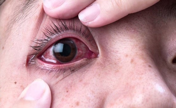 Bệnh đau mắt đỏ và cách phòng ngừa