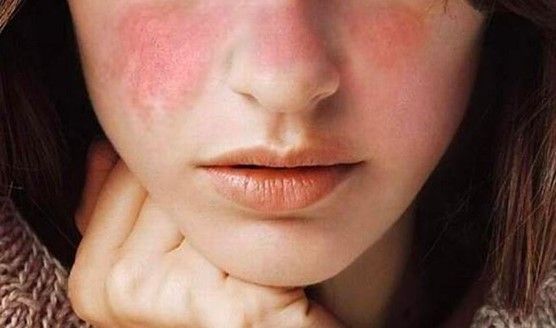 Dị ứng mỹ phẩm: Dấu hiệu nhận biết và cách xử lý kịp thời cho da