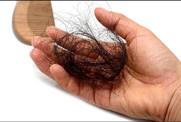 Rụng tóc nhiều là dấu hiệu của bệnh gì?
