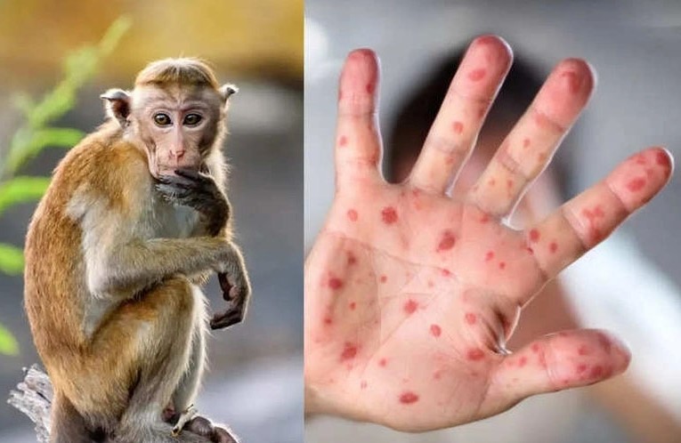 Bệnh đậu mùa khỉ có dấu hiệu gì?
