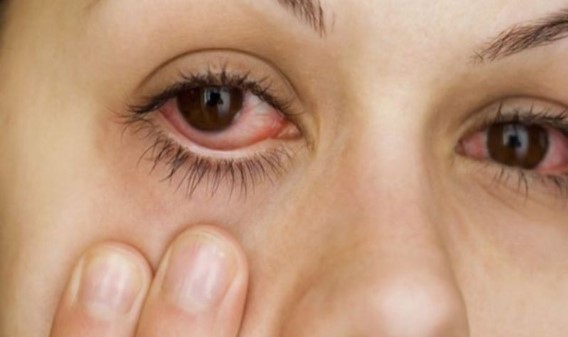 Đau mắt đỏ khi mang thai có nguy hiểm không? Cách giảm đau mắt đỏ ở mẹ bầu