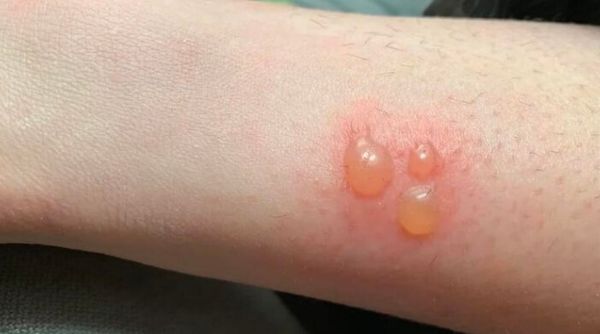 Bị bỏng bôi mỡ trăn có được không