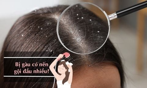 BỊ GÀU CÓ NÊN GỘI ĐẦU NHIỀU? SAI LẦM KHI GỘI ĐẦU VẪN BỊ GÀU