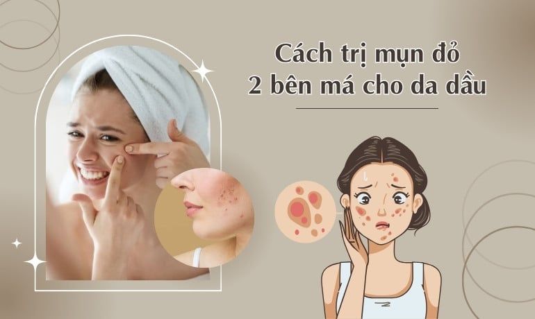 Cách trị mụn đỏ 2 bên má cho da dầu: Giải pháp hiệu quả và an toàn