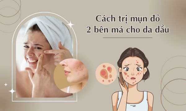 7 CÁCH TRỊ MỤN ĐỎ 2 BÊN MÁ CHO DA DẦU HIỆU QUẢ TẠI NHÀ