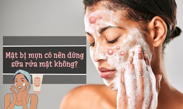 MẶT BỊ MỤN CÓ NÊN DÙNG SỮA RỬA MẶT KHÔNG? LOẠI NÀO GIẢM MỤN TỐT?