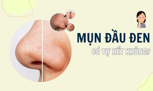 MỤN ĐẦU ĐEN ĐỂ LÂU CÓ TỰ HẾT ĐƯỢC HAY KHÔNG