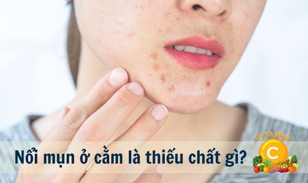 NỔI MỤN Ở CẰM LÀ DẤU HIỆU CƠ THỂ THIẾU CHẤT GÌ