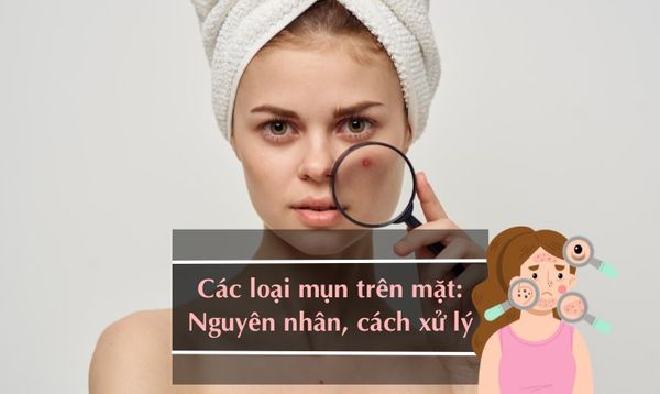 CÁCH PHÂN BIỆT CÁC LOẠI MỤN TRÊN KHUÔN MẶT VÀ ĐIỀU TRỊ HIỆU QUẢ