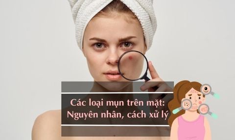 CÁCH PHÂN BIỆT CÁC LOẠI MỤN TRÊN KHUÔN MẶT VÀ ĐIỀU TRỊ HIỆU QUẢ