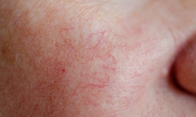 Rửa mặt bằng nước đá có tác dụng gì, có tốt cho da không?