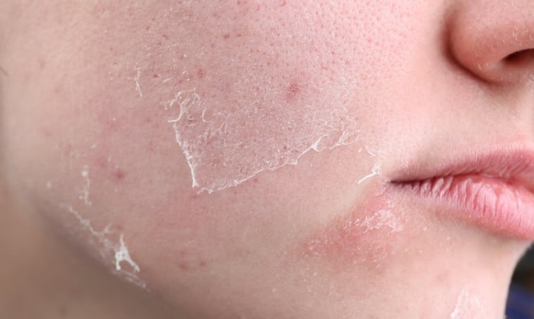 Glycerin thực vật là gì trong mỹ phẩm và có tác dụng gì?