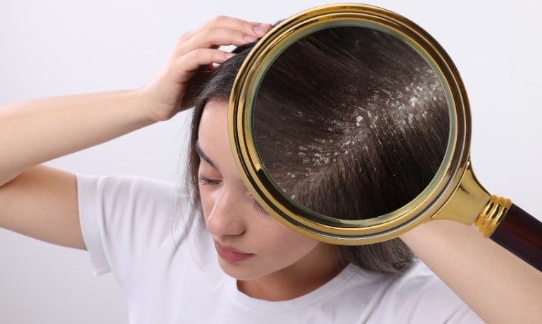 Nên gội đầu bằng nước ấm hay nước lạnh để giảm gàu, ngừa rụng?