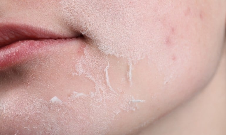 Da mặt bị khô bong tróc phải làm sao, cách chăm sóc đúng?