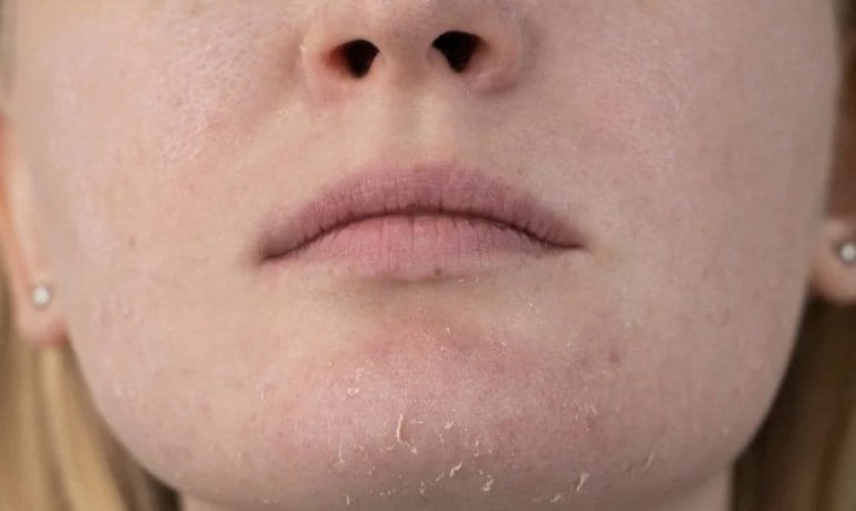 Da mặt bị khô bong tróc phải làm sao, cách chăm sóc đúng?