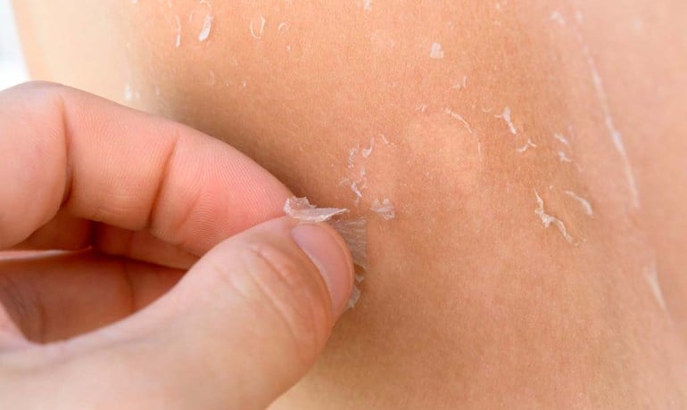 Da mặt bị khô bong tróc phải làm sao, cách chăm sóc đúng?