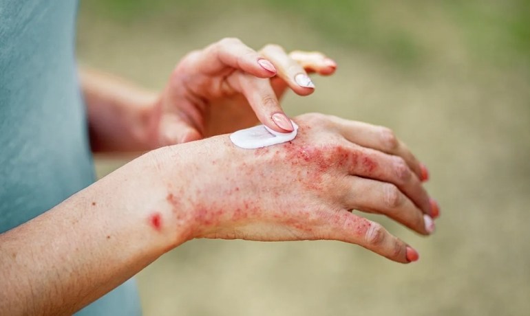 Da tay bị bong tróc là thiếu chất gì? Cách ngăn ngừa