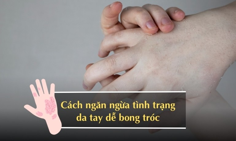 Da tay bị bong tróc là thiếu chất gì? Cách ngăn ngừa