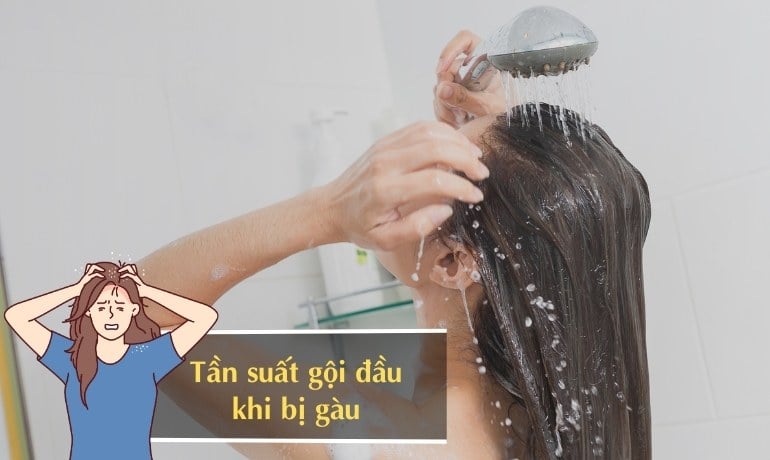Bị gàu có nên gội đầu nhiều không và cách gội đúng