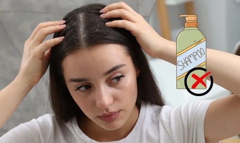 Bị gàu có nên gội đầu nhiều không và cách gội đúng
