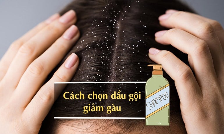 Bị gàu có nên gội đầu nhiều không và cách gội đúng