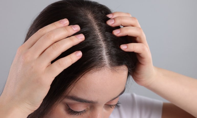 Bị gàu có nên gội đầu nhiều không và cách gội đúng