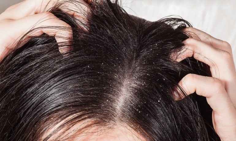 Có nên gội đầu mỗi ngày không? Gội đầu nhiều có hại cho tóc không?