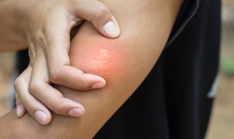Diethyltoluamide (DEET) là gì, có độc không?