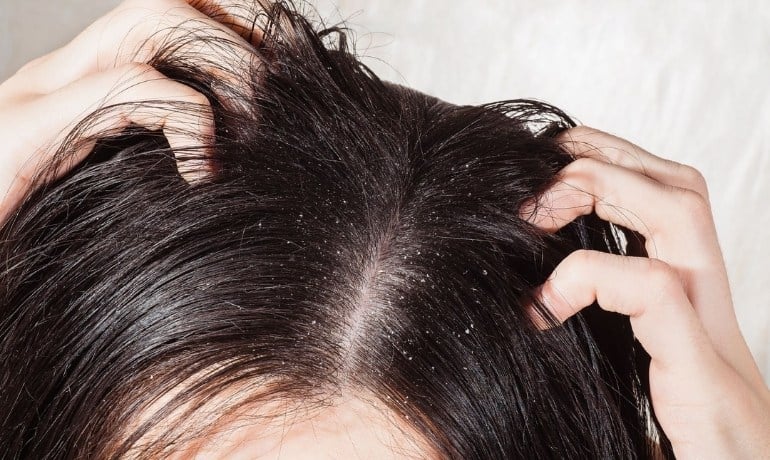 Nên tẩy tế bào chết da đầu trước hay sau khi gội đầu?