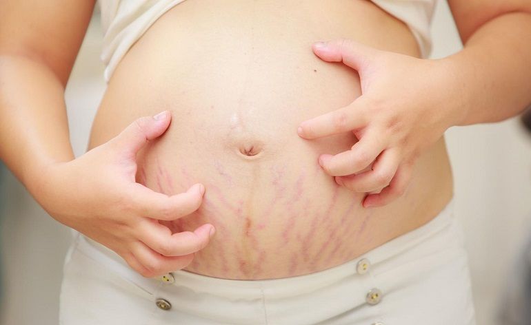 Lý giải các vị trí nổi mụn khi mang thai và hướng dẫn điều trị