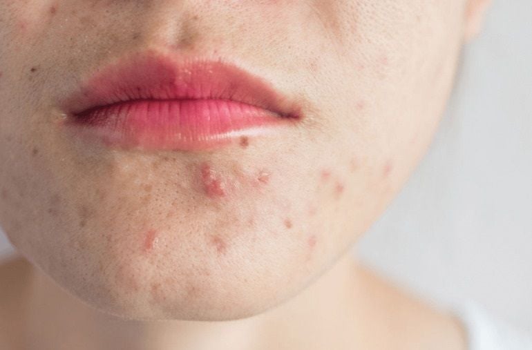 Lý giải các vị trí nổi mụn khi mang thai và hướng dẫn điều trị