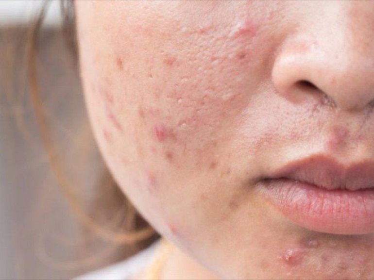 Lý giải các vị trí nổi mụn khi mang thai và hướng dẫn điều trị