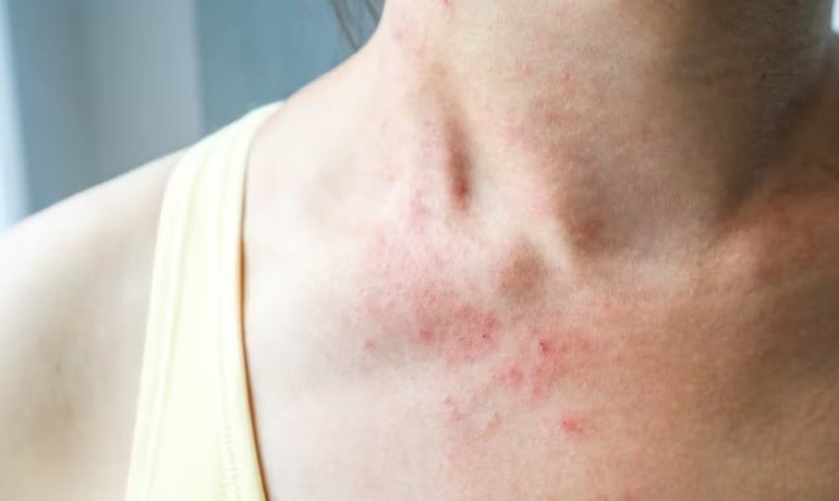 Sodium Laureth Sulfate là gì, có gây hại cho da không?