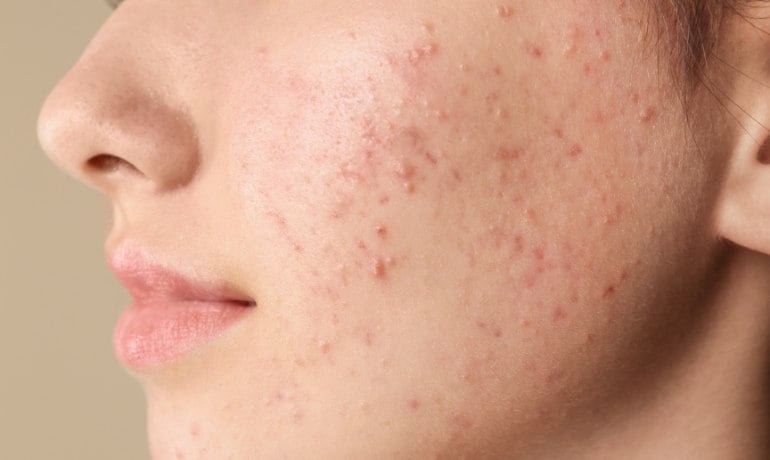 Cách phân biệt và điều trị các loại mụn trên khuôn mặt