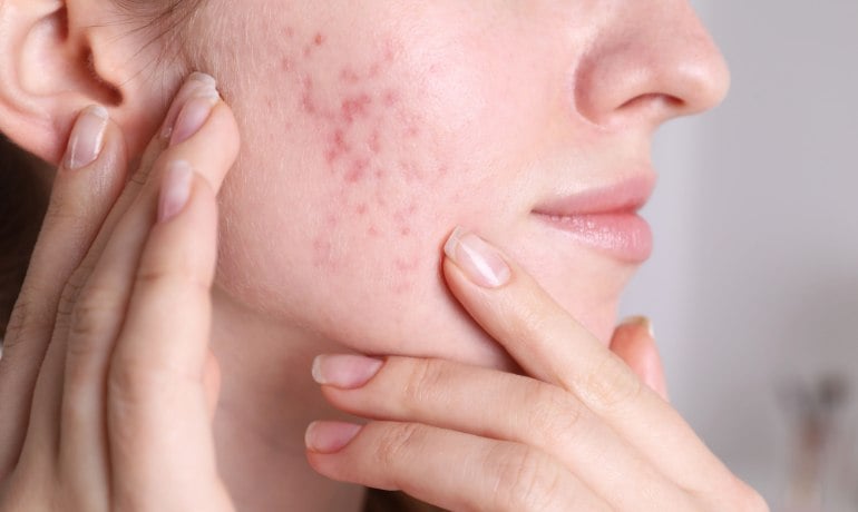 Cách phân biệt và điều trị các loại mụn trên khuôn mặt