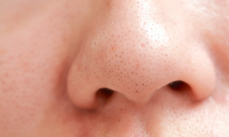 Cách phân biệt và điều trị các loại mụn trên khuôn mặt