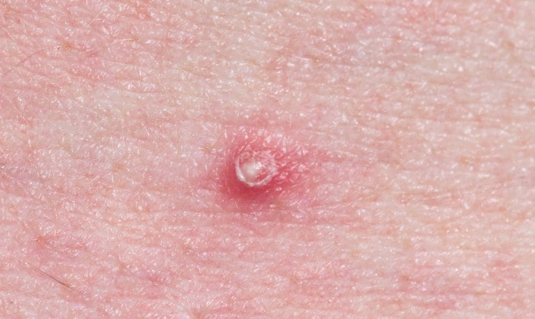 Cách phân biệt và điều trị các loại mụn trên khuôn mặt