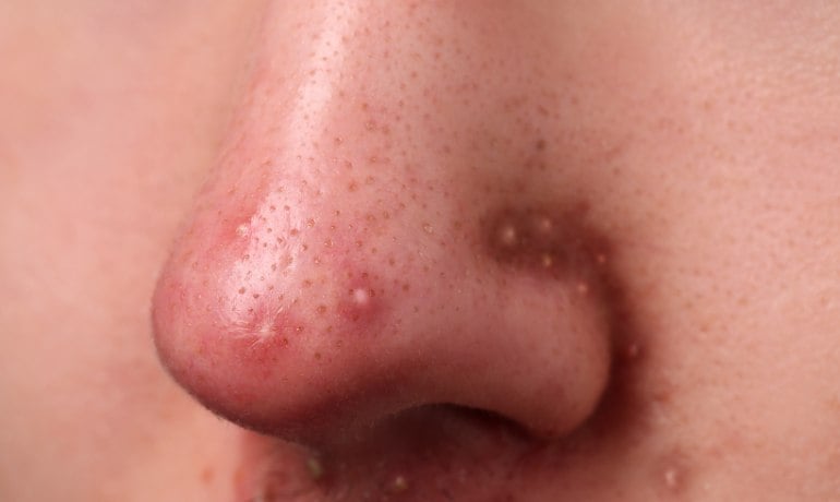 Cách phân biệt và điều trị các loại mụn trên khuôn mặt