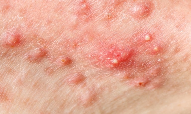 Cách phân biệt và điều trị các loại mụn trên khuôn mặt