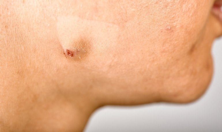 Cách phân biệt và điều trị các loại mụn trên khuôn mặt