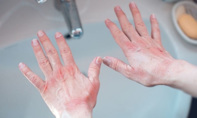 Rửa tay bằng nước rửa chén có sao không? Cách dùng đúng