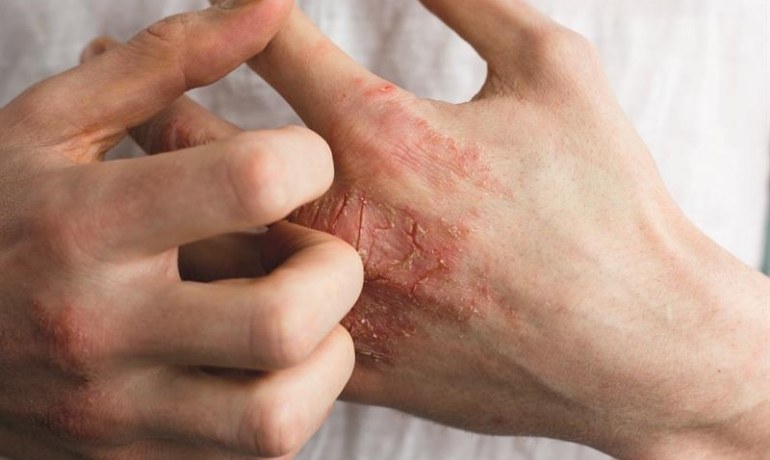 Rửa tay bằng nước rửa chén có sao không? Cách dùng đúng