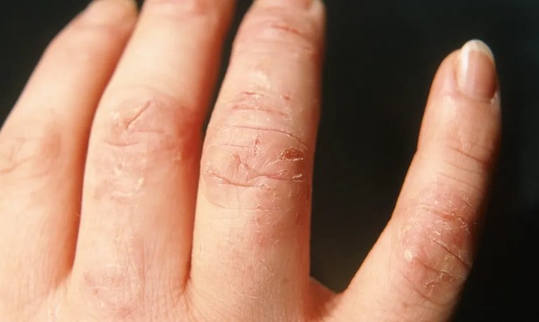 Rửa tay bằng nước rửa chén có sao không? Cách dùng đúng