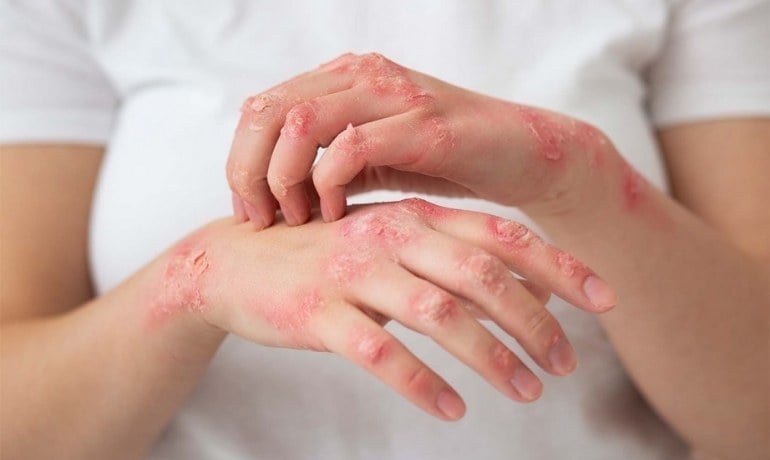 Nguyên nhân và cách xử lý tay bị xà phòng ăn phải làm sao?