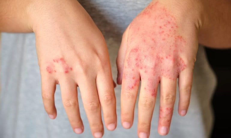 Nguyên nhân và cách xử lý tay bị xà phòng ăn phải làm sao?