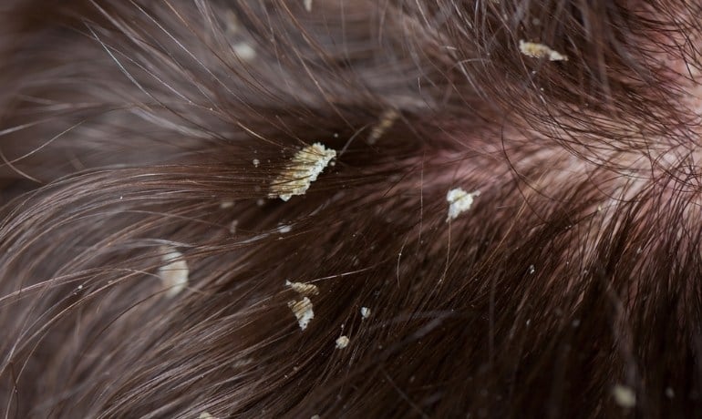 Tẩy tế bào chết da đầu bằng muối có tốt không? Cách làm