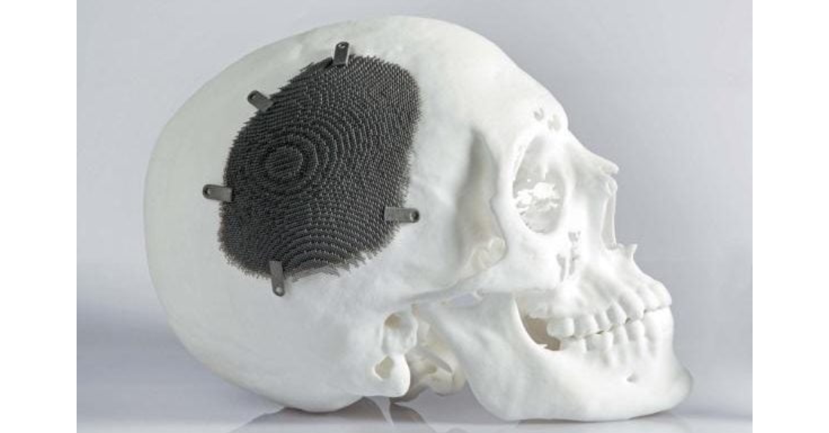 Ứng dụng in 3D trong y tế